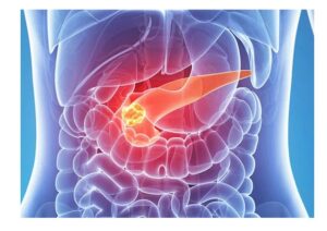 neuro endocrine tumours
