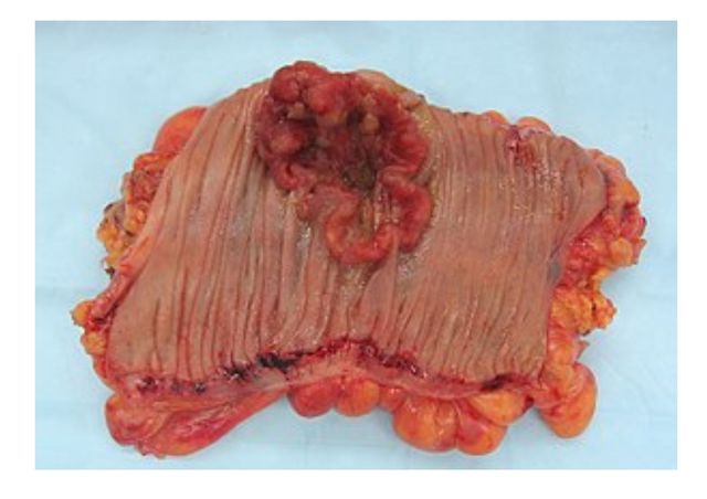 neoplasm