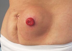 para stomal hernia